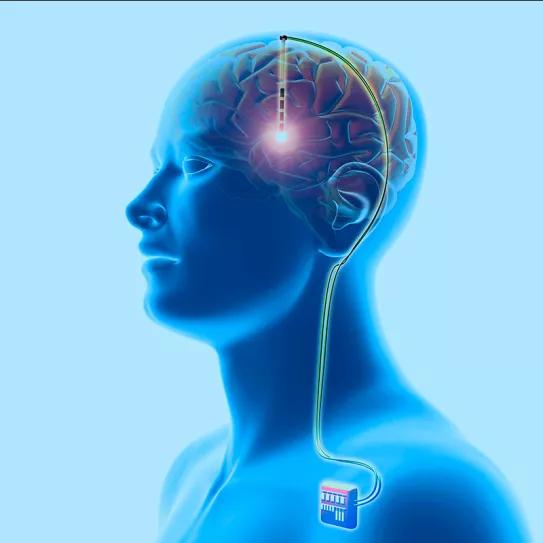 Una universidad estadounidense estudia la cirugía para tratar la adicción