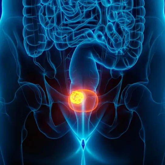 Extractos de cannabis frenan células de cáncer de vejiga