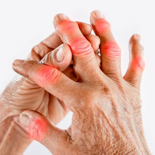 El CBG muestra potencial frente a la artritis reumatoide 