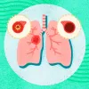 Cannabinoide sintético reduce inflamación asmática en ratones
