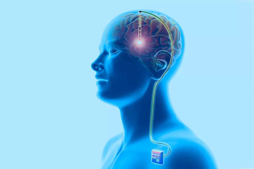 Una universidad estadounidense estudia la cirugía para tratar la adicción