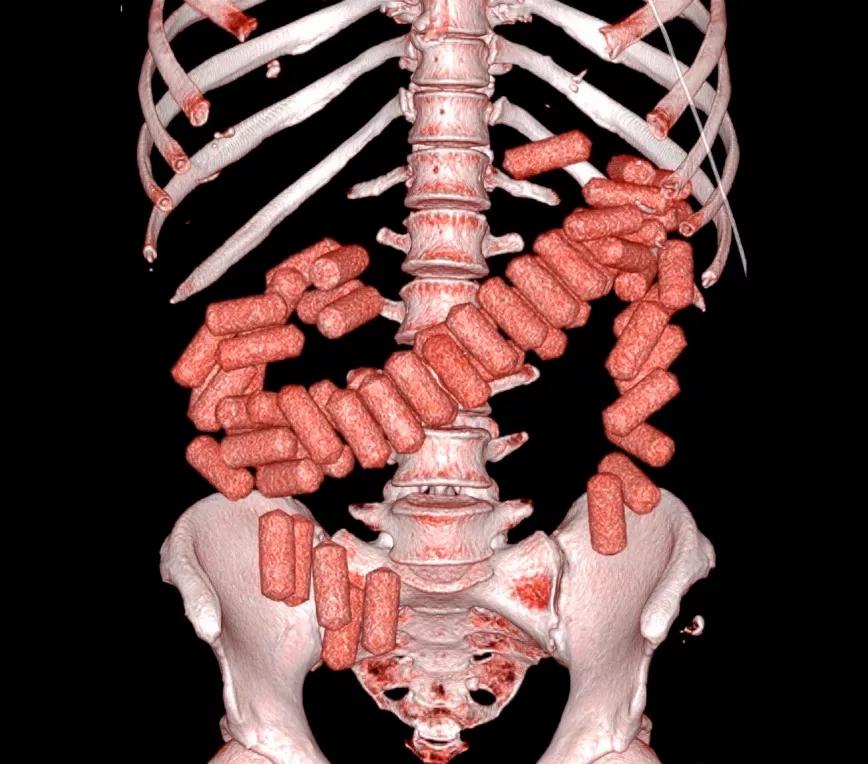Tres detenidos por la muerte de una persona que transportó cocaína en su interior