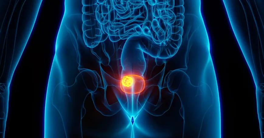 Extractos de cannabis frenan células de cáncer de vejiga