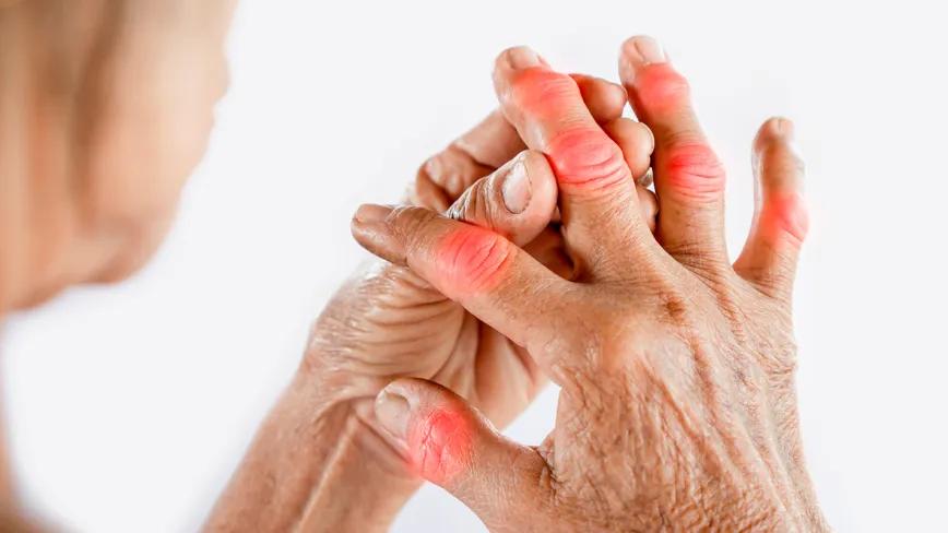 El CBG muestra potencial frente a la artritis reumatoide 