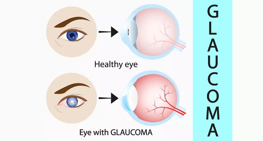 Glaucoma